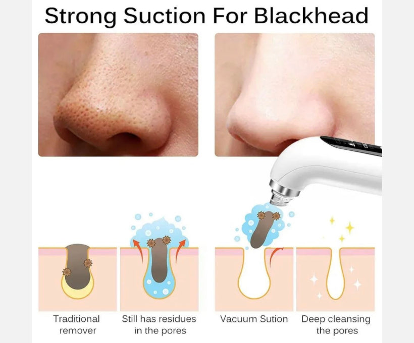 Professional Blackhead Vacuum – Deep Pore Cleaner Device