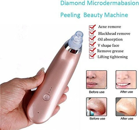 Professional Blackhead Vacuum – Deep Pore Cleaner Device